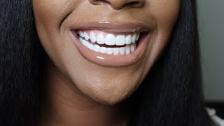 $400 Veneers At Home? VERY Affordable Smile Makeover | Shiny Smile Veneers Review | Dolce Mateo