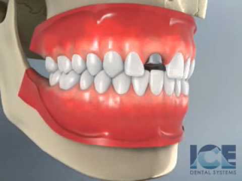 Dental Implants