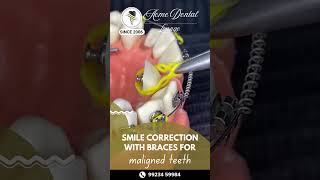 Smile Correction Braces for  Malaligned  Teeth | Acme Dental Lounge | Pune