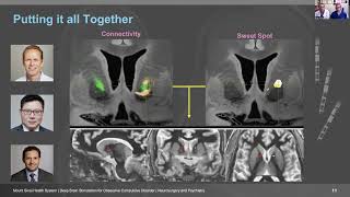 Deep Brain Stimulation (DBS) for Obsessive-Compulsive Disorder (OCD)