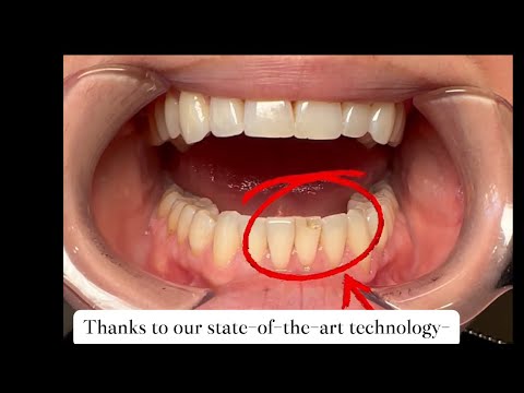 Same-Day Emergency Veneer | Broken Tooth Fixed in ONE Visit