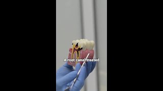 Is it painful to extract a root canal tooth?