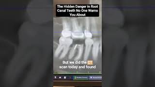 The Hidden Danger in Root Canal Teeth No One Warns You About #shorts