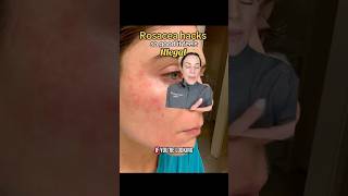 Rosacea HACKS So Good It Feels Illegal — From A Derm | #shorts #skincare |