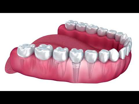 FAQ - What is the process of getting a dental implant? | Matthew Nawrocki DMD, MS