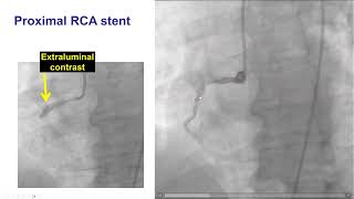 Managing PCI Complications. Dr Manos Brilakis. Dec 17 2025