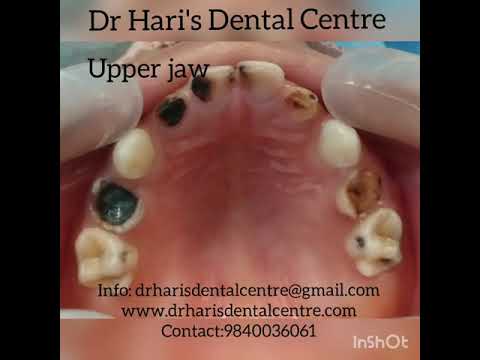 #General anaesthesia #pulpectpmy# stainless steel crown# zirconia crown