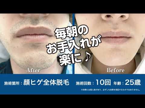 ヒゲ・ムダ毛にお悩みの方、必見！山梨県富士吉田市のメンズ脱毛サロンガランテリー
