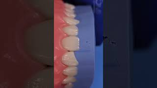 Dental motivation. Direct composite restoration teeth. Composite veneers #dental #dentistry #veneers