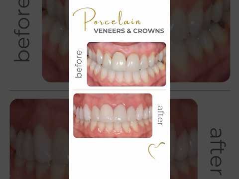 Smile Makeover with Veneers & Crowns - Before and After #cosmeticdental