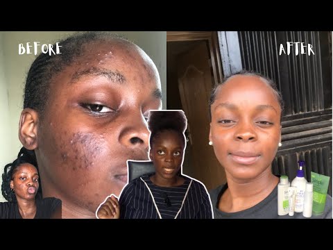 MY ACNE JOURNEY: GOD HEALED ME, SKIN TRANSFORMATION, PRODUCTS USED & LESSONS LEARNT
