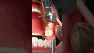Crown Preparation​ 🦷 (Part 3) #dentist​#dental #crown #prosthodontics