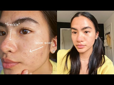 hiding acne scars with fake tan freckles (unsuccessful-ish attempt)