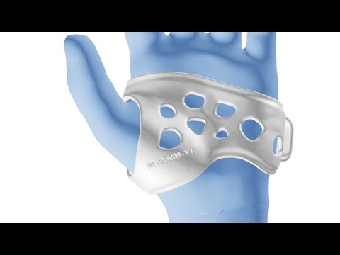 Automated Workflow for Orthotics and Prosthetics - Spentys Demo
