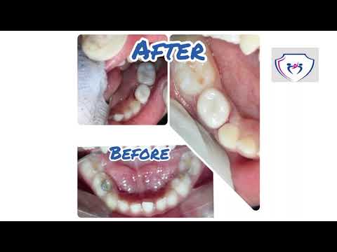 FULL MOUTH FUNCTIONAL REHABILITATION UNDER GA WITH ZIRCONIA CROWNS AND DE NOVA SPACE MAINTAINER