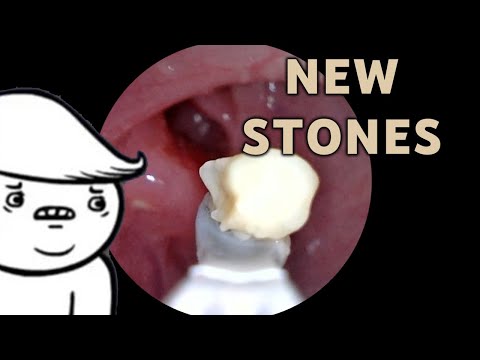 New Year New Tonsil Stones | AIM 25