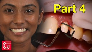 HOW TO Deliver Zirconia Crowns on ANTERIOR Teeth