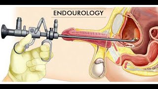 Laparoscopy ureterolithotomy CPT code - simplify medical coding