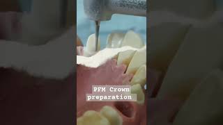 Reduction for canine #preparation #Reduction #dr_ghazal