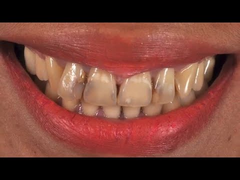 Wow Amazing!! Direct Restoration from scratch (isolation -result)..