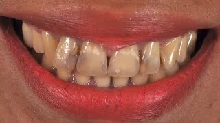 Wow Amazing!! Direct Restoration from scratch (isolation -result)..