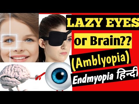 Lazy eye | Amblyopia | Patching | Endmyopia Hindi | कैसे ठीक करे |How to treat lazy eye in kids|#8