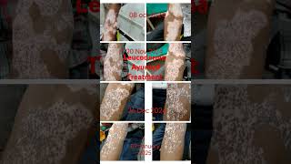 #skincare #leucoderma #skincareroutine #ayurveda #treatmentforallbodyparts #beauty