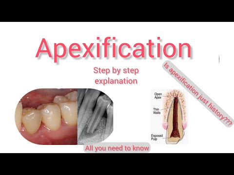 Apexification, for non-vital immature permanent teeth, all you need to know, clinical steps.