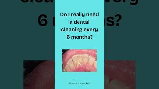How Often Should You Get Your Teeth Cleaned? #dentaltips #teethhygiene #dentalhygienist #shorts