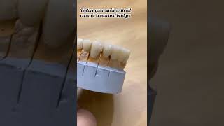 Smile Rehabilitation #denture #crownandbridge #smiledesign #dentalclinic #dentalcare #dentistry