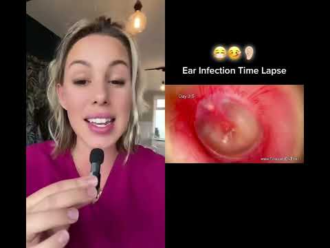 #earinfection #otitismedia also know as a #middleearinfection it’s an infection behind the #eardrum