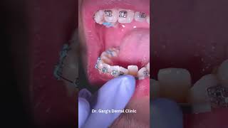 Braces equal Beautiful Smiles!