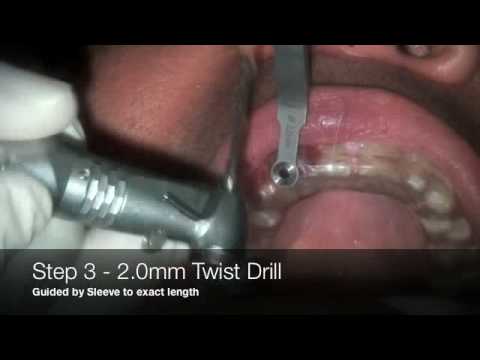 Guided Implant #7