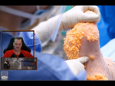 Dr Shaves off gross foot growths... my Reaction and Comments.