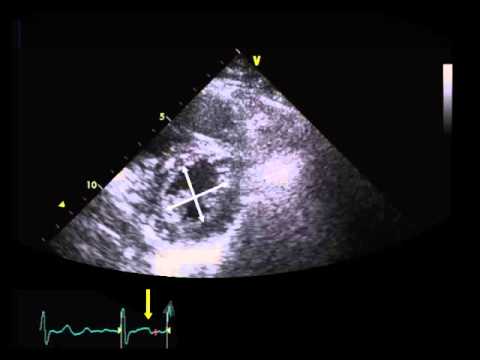 20. Normal septal motion in systole (LVEI)
