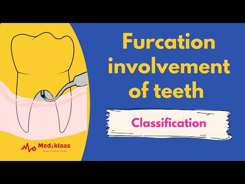 Furcation involvement of teeth - Classification