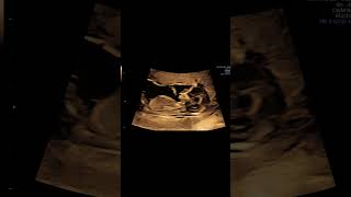 Key features detected in NT scan #drvandanaa #ntscan #scan #shukrandiagnostics