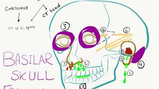 10 Signs and Symptoms Of Basilar Skull Fracture (Basal Skull Fracture)