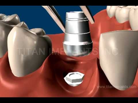 Titan Implant Locator Pin