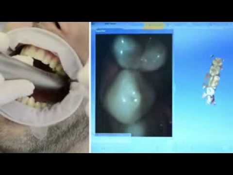 Cerec Omnicam vs Cerec Blue Cam Ceramics Dental Lab Miami