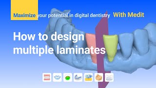 Maximize Your Potential - Laminate Veneer CAD Design