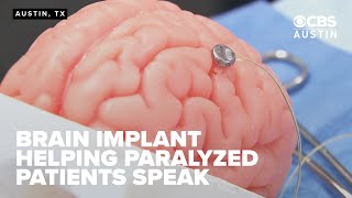 Austin's Paradromics advances Brain-Computer Interface with successful surgery