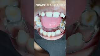 Preserving Your Child’s Smile: Kids Dental care with Space Maintainers