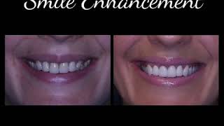 Smile Enhancement