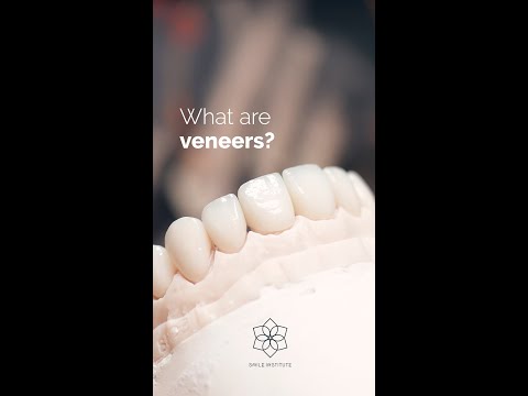 What are veneers? #FAQs