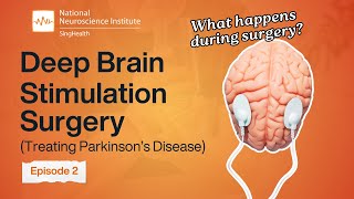 What Happens in Surgery? Treatment for Parkinson's Disease | Deep Brain Stimulation (DBS) Explained!