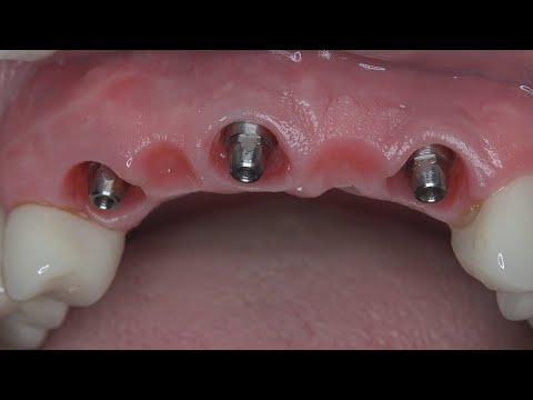 Short implants: Prosthetic planning tips