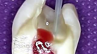 Pulpotomy Procedure: This is How Tooth is Cleaned and Prepared for Dental (Cavity / Tooth) Filling