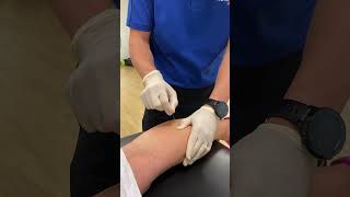 Dry Needling for Calf Pain