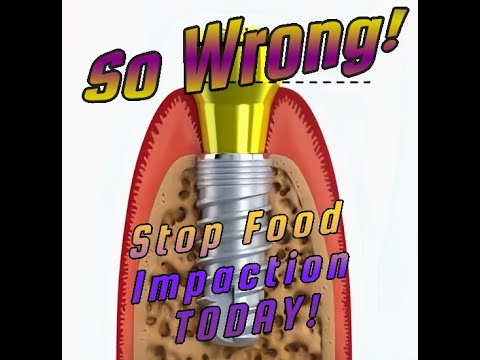 Dentists!  Eliminate food impaction TODAY!